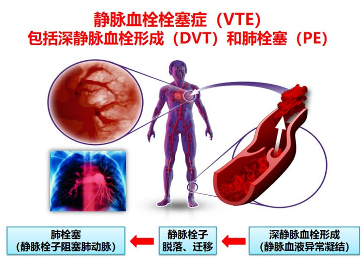 世界血栓日 | 拴不住，動起來